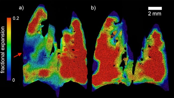 World-first technology breathes new life into cystic fibrosis detection and treatment