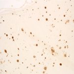 New study confirms link between sleep apnea and Alzheimer’s disease Study confirms link between sleep apnea and Alzheimer's disease