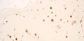 New study confirms link between sleep apnea and Alzheimer’s disease Study confirms link between sleep apnea and Alzheimer's disease
