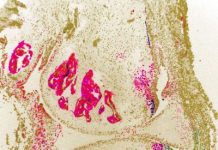 Biology: When it comes to arthritic bone spurs, stem cells hurt instead of heal