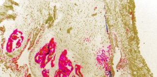 Biology: When it comes to arthritic bone spurs, stem cells hurt instead of heal