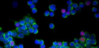 Research: Severe Coronavirus infection linked to overactive immune cells