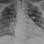 Research: Diabetes, hypertension may increase risk of Coronavirus brain complications