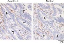 Biology: Research finds potential therapeutic targets to inhibit colorectal cancer progression