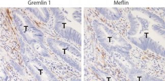 Biology: Research finds potential therapeutic targets to inhibit colorectal cancer progression