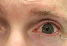 Biology: Soft contact lenses eyed as new solutions to monitor ocular diseases