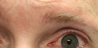 Biology: Soft contact lenses eyed as new solutions to monitor ocular diseases