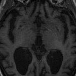 AI could detect dementia years before symptoms appear (Study) AI could detect dementia years before symptoms appear (Study)