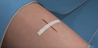 Suturing reported to be better than stapling for skin closure Suturing reported to be better than stapling for skin closure