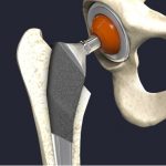 New research: Sugar could help repair artificial human joints New research: Sugar could help repair artificial human joints