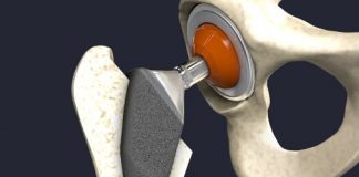 New research: Sugar could help repair artificial human joints New research: Sugar could help repair artificial human joints