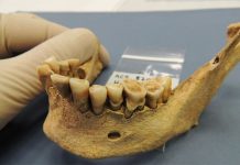 Prehistoric people knew how to prevent tooth decay Prehistoric people knew how to prevent tooth decay