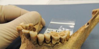 Prehistoric people knew how to prevent tooth decay Prehistoric people knew how to prevent tooth decay