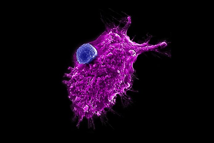 Researchers make strides toward an ‘off-the-shelf’ immune cell therapy for cancer