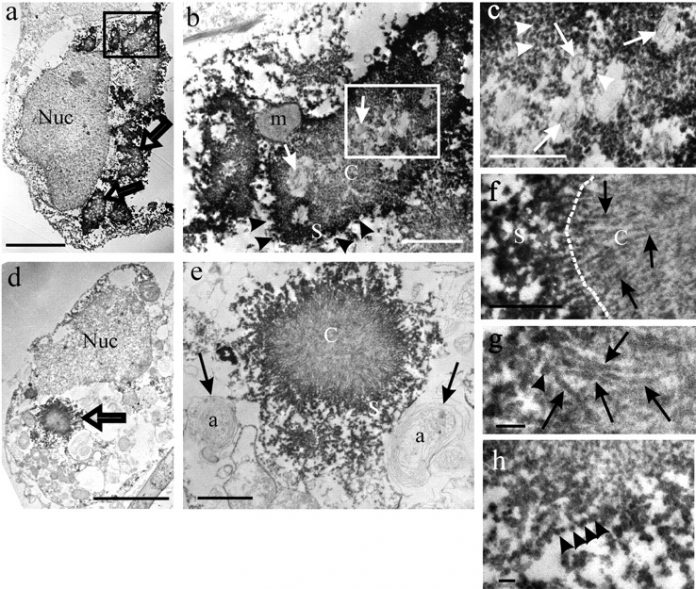 Study: The ultrastructure of huntingtin inclusions revealed