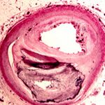 Coronary Artery Disease underrated in women despite death rate Coronary Artery Disease underrated in women despite death rate