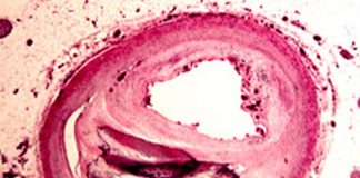 Coronary Artery Disease underrated in women despite death rate Coronary Artery Disease underrated in women despite death rate