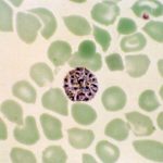 Research points to novel method of detecting complications caused by P. vivax in malaria patients Research points to novel method of detecting complications caused by P. vivax in malaria patients