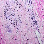 Sarcoidosis suffers hear it all the time: ‘You don’t look sick!’ Sarcoidosis suffers hear it all the time: ‘You don’t look sick!’