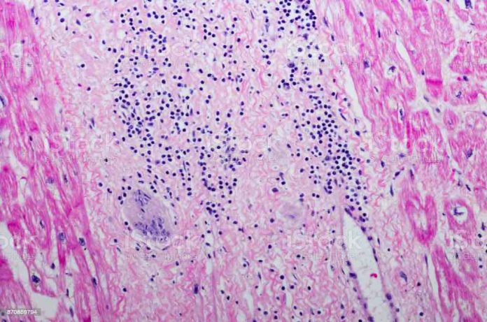 Sarcoidosis suffers hear it all the time: ‘You don’t look sick!’