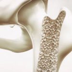 JU-developed hybrid materials to combat osteoporosis JU-developed hybrid materials to combat osteoporosis