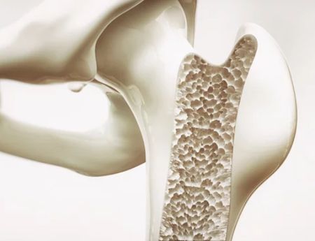 JU-developed hybrid materials to combat osteoporosis
