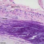 Nanoparticles developed to repair arteries, preventing heart attacks and strokes Nanoparticles developed to repair arteries, preventing heart attacks and strokes