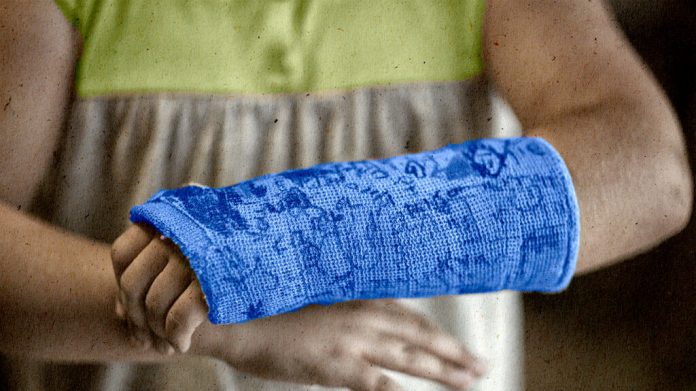 Research: Metal pins no better than traditional plaster cast for a broken wrist