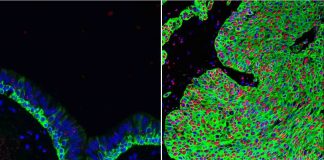 New UCLA research may lead to lung cancer prevention New UCLA research may lead to lung cancer prevention