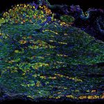 Researchers identify neural disruptions underlying feeding, swallowing disorders in children Researchers identify neural disruptions underlying feeding, swallowing disorders in children