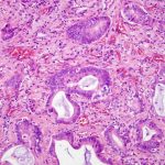 UCLA researchers slow the spread of creeping skin cancer cells UCLA researchers slow the spread of creeping skin cancer cells