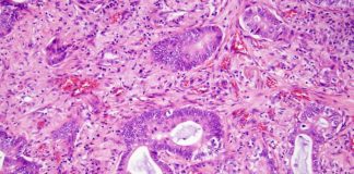 UCLA researchers slow the spread of creeping skin cancer cells UCLA researchers slow the spread of creeping skin cancer cells