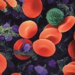 Aspirin may slow down the progression of emphysema Aspirin may slow down the progression of emphysema