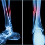 Bone fractures should prompt abuse screening Bone fractures should prompt abuse screening