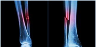 Bone fractures should prompt abuse screening Bone fractures should prompt abuse screening