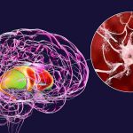 UCLA researchers gain further insight into Huntington’s disease UCLA researchers gain further insight into Huntington’s disease