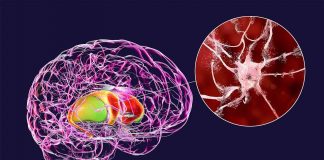 UCLA researchers gain further insight into Huntington’s disease UCLA researchers gain further insight into Huntington’s disease