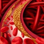 Study: How the brain controls atherosclerosis Study: How the brain controls atherosclerosis