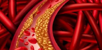 Study: How the brain controls atherosclerosis Study: How the brain controls atherosclerosis