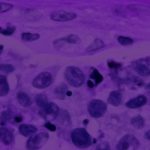 New research identifies unique underlying molecular factors driving melanoma development New research identifies unique underlying molecular factors driving melanoma development