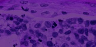 New research identifies unique underlying molecular factors driving melanoma development New research identifies unique underlying molecular factors driving melanoma development