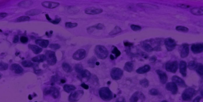 New research identifies unique underlying molecular factors driving melanoma development