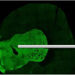 Schizophrenia may be diagnosed in the future from nerve cells in the nose Schizophrenia may be diagnosed in the future from nerve cells in the nose