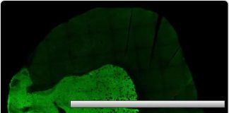 Schizophrenia may be diagnosed in the future from nerve cells in the nose Schizophrenia may be diagnosed in the future from nerve cells in the nose
