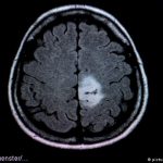 Scientists identify pathway that regulates angiogenesis in tumors Scientists identify pathway that regulates angiogenesis in tumors