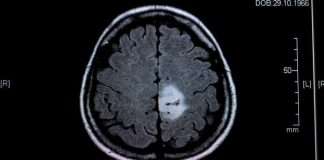 Scientists identify pathway that regulates angiogenesis in tumors Scientists identify pathway that regulates angiogenesis in tumors