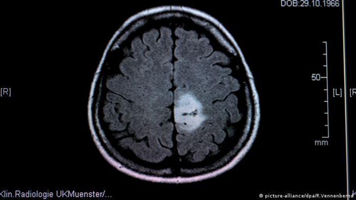 Scientists identify pathway that regulates angiogenesis in tumors