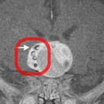 Doctors Find Teeth Growing Inside Infant Boy’s Brain Doctors Find Teeth Growing Inside Infant Boy's Brain