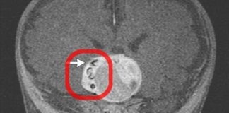 Doctors Find Teeth Growing Inside Infant Boy’s Brain Doctors Find Teeth Growing Inside Infant Boy's Brain