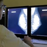Does bilateral mastectomy for breast cancer increase survival? Does bilateral mastectomy for breast cancer increase survival?